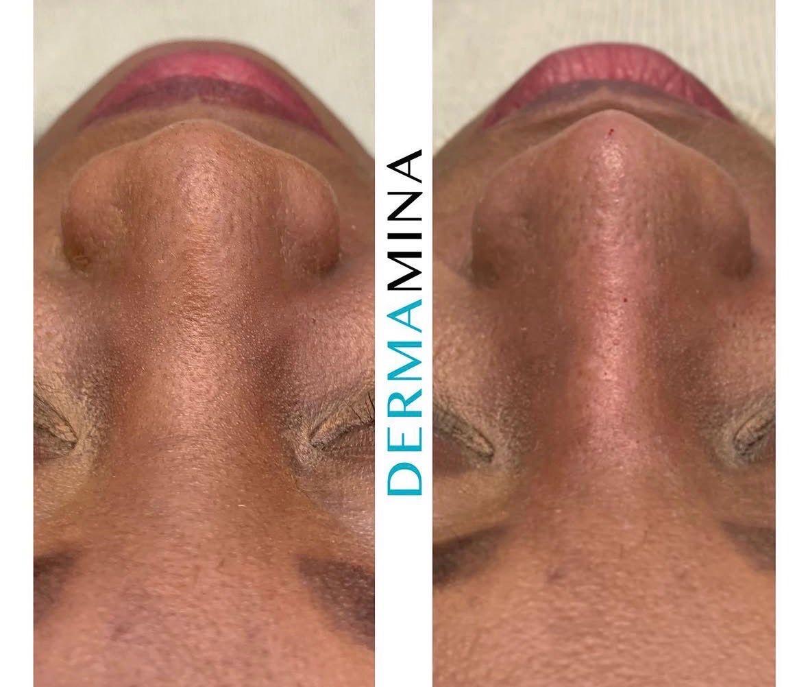 Non-surgical nose job before and after at Dermamina London, wide nose slimmed and narrowed