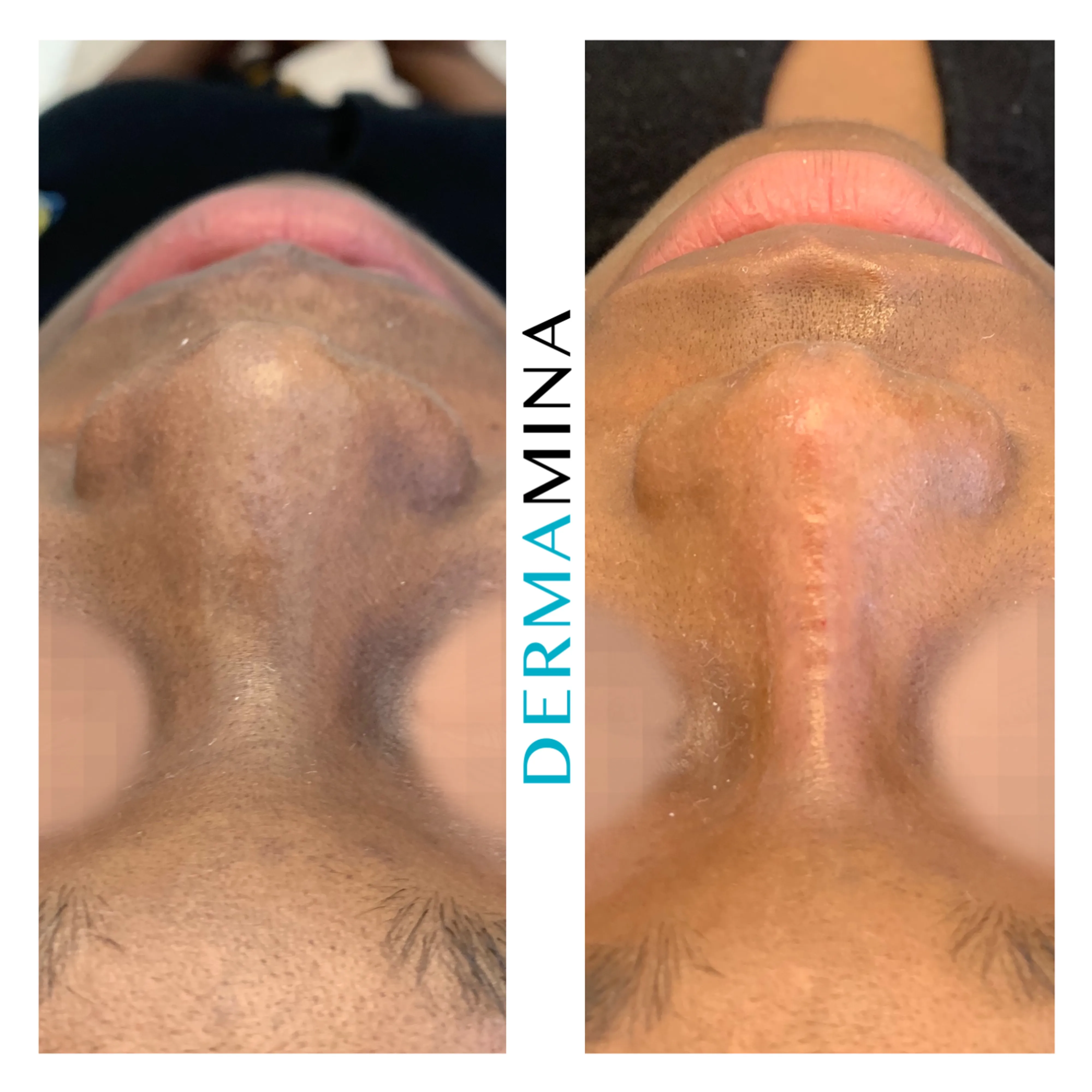 Non-surgical nose job before and after at Dermamina London, wide nose slimmed and narrowed