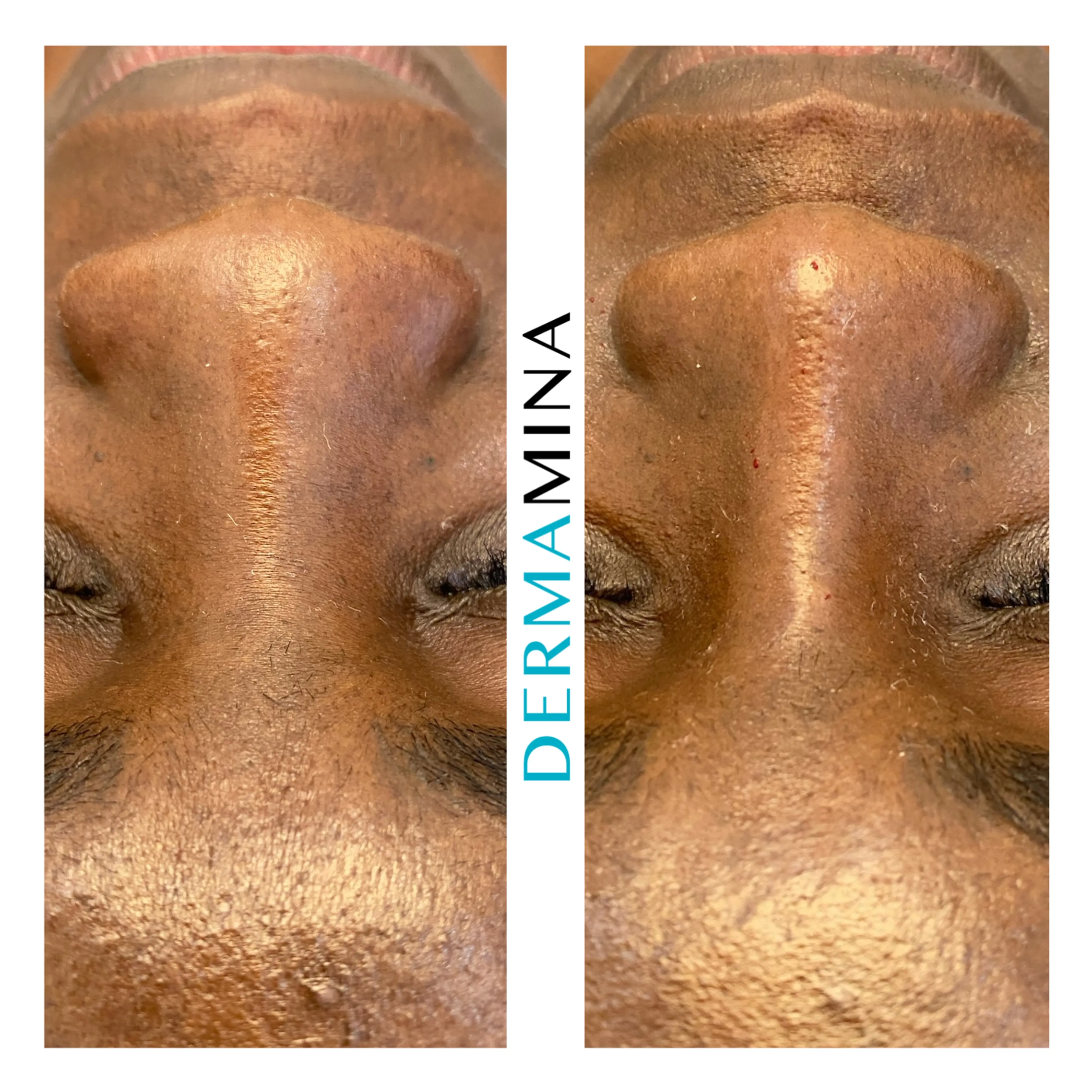 Non-surgical nose job before and after at Dermamina London, wide nose slimmed and narrowed