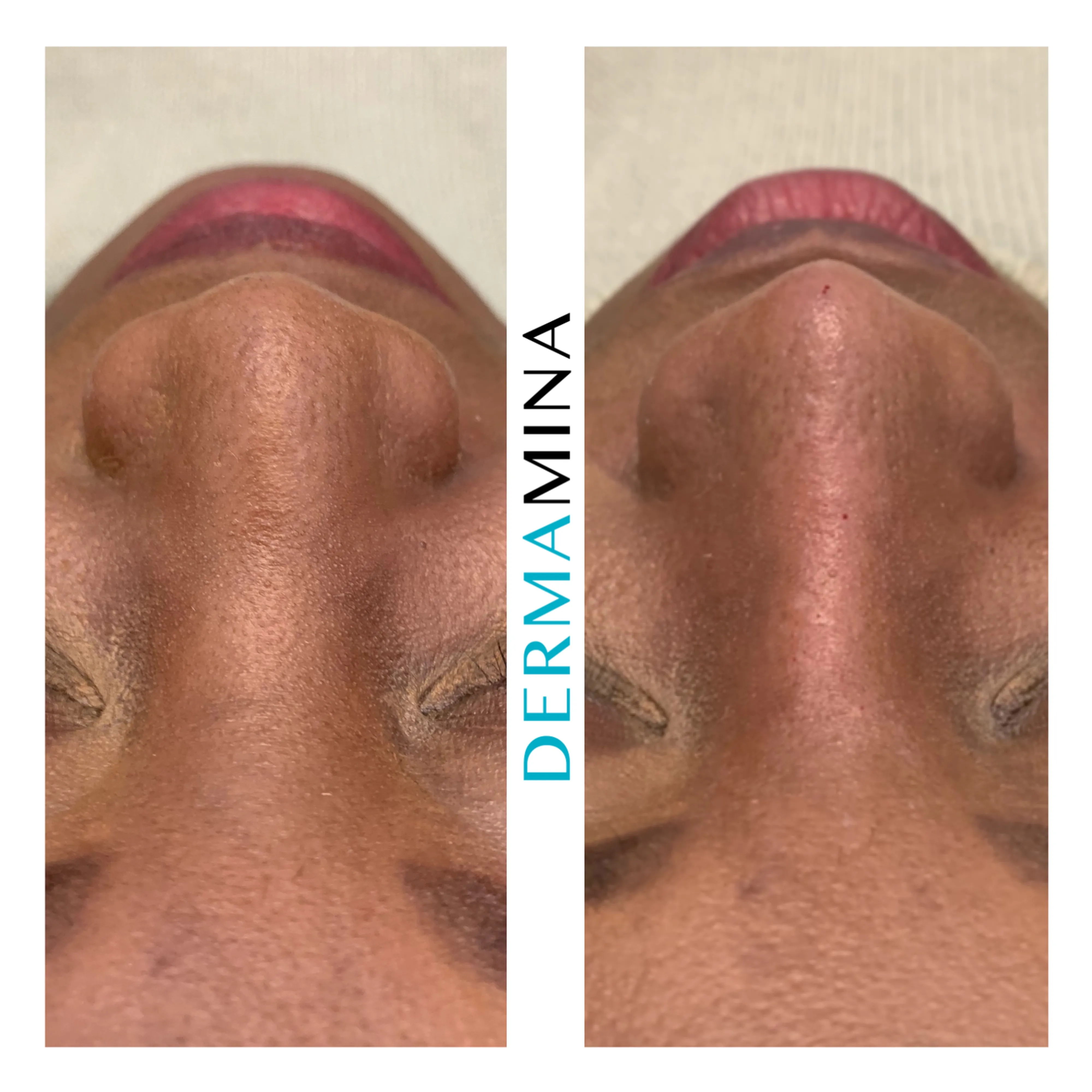 Non-surgical nose job before and after at Dermamina London, wide nose slimmed and narrowed