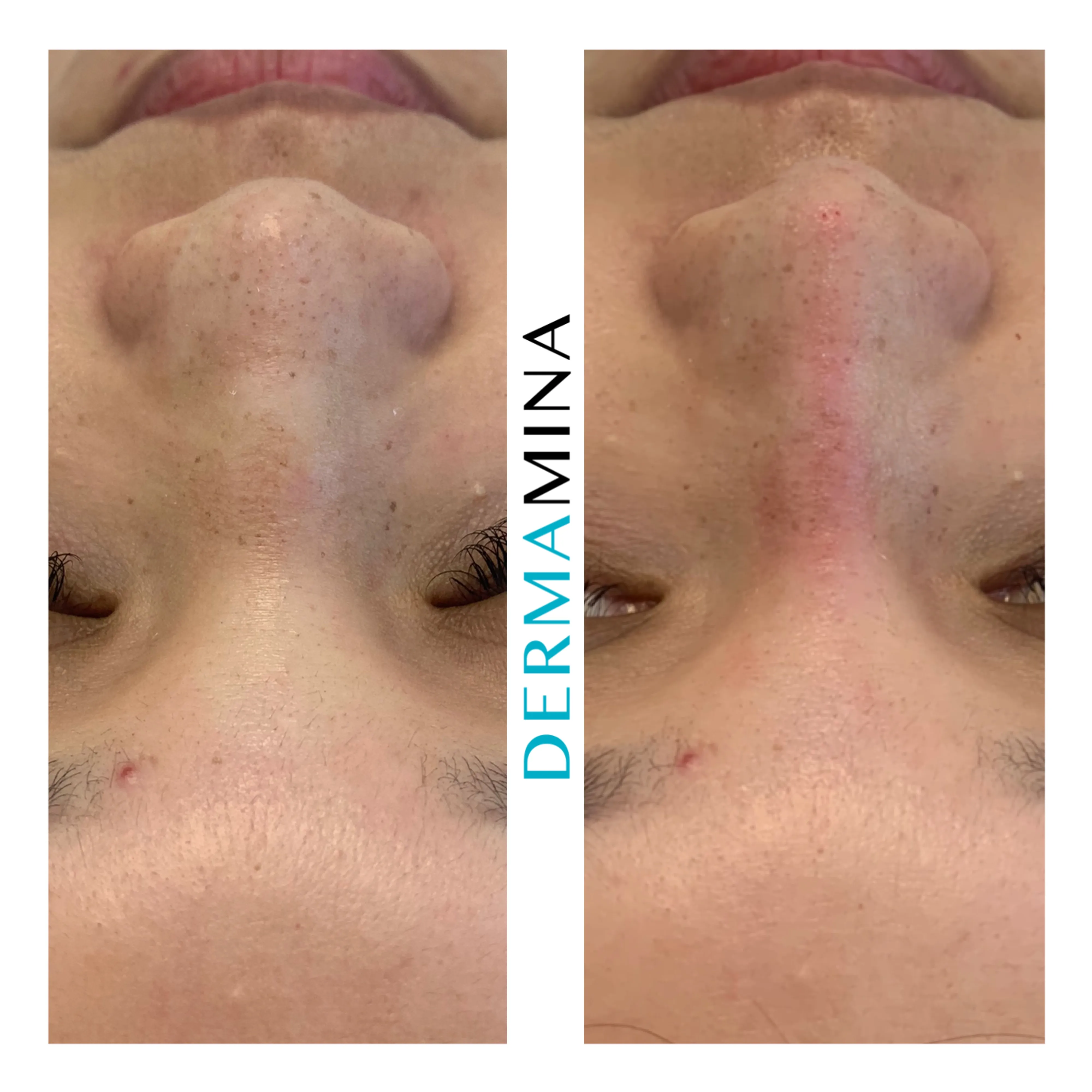 Non-surgical nose job before and after at Dermamina London, wide nose slimmed and narrowed