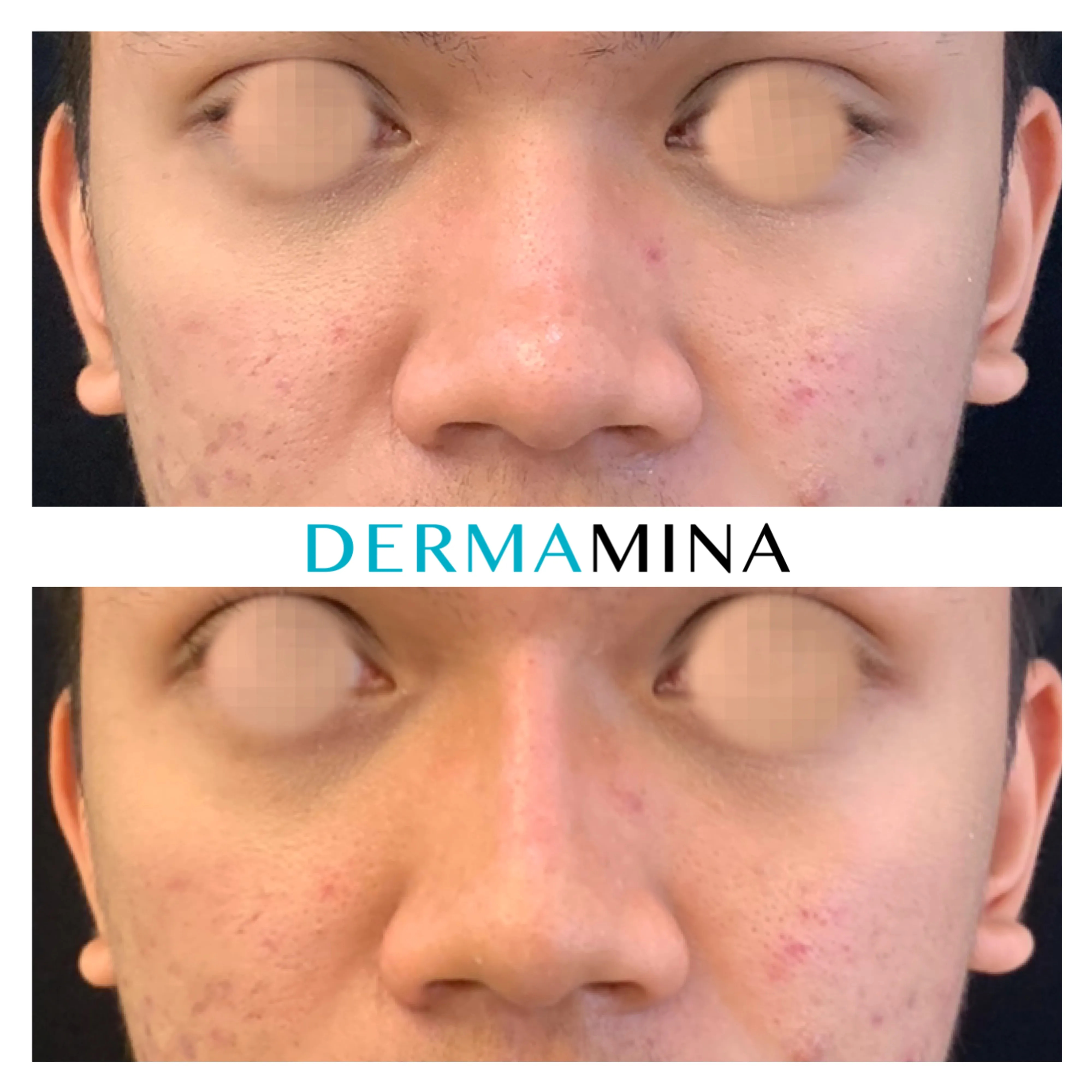 Non-surgical nose job before and after at Dermamina London, wide nose slimmed and narrowed