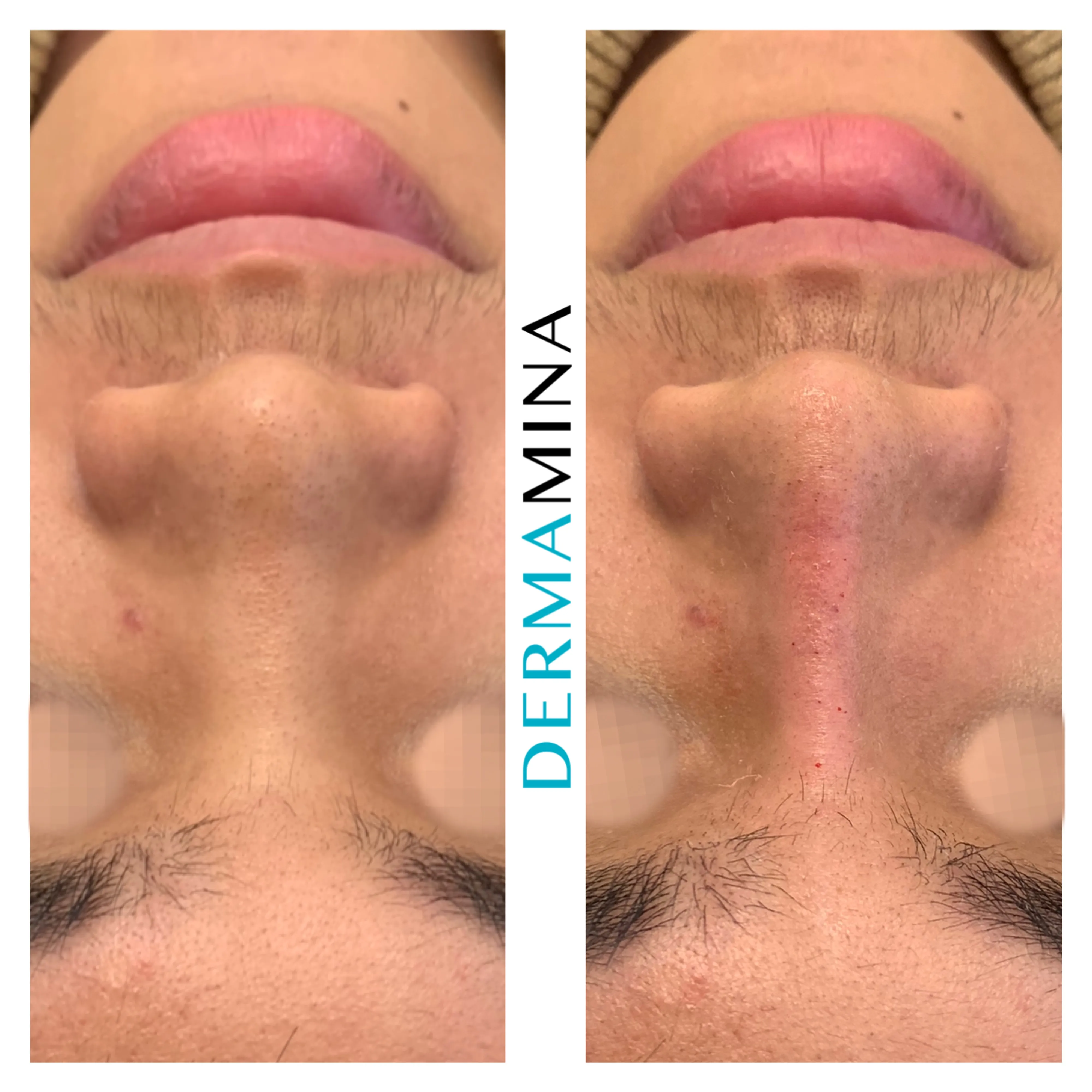 Non-surgical nose job before and after at Dermamina London, wide nose slimmed and narrowed