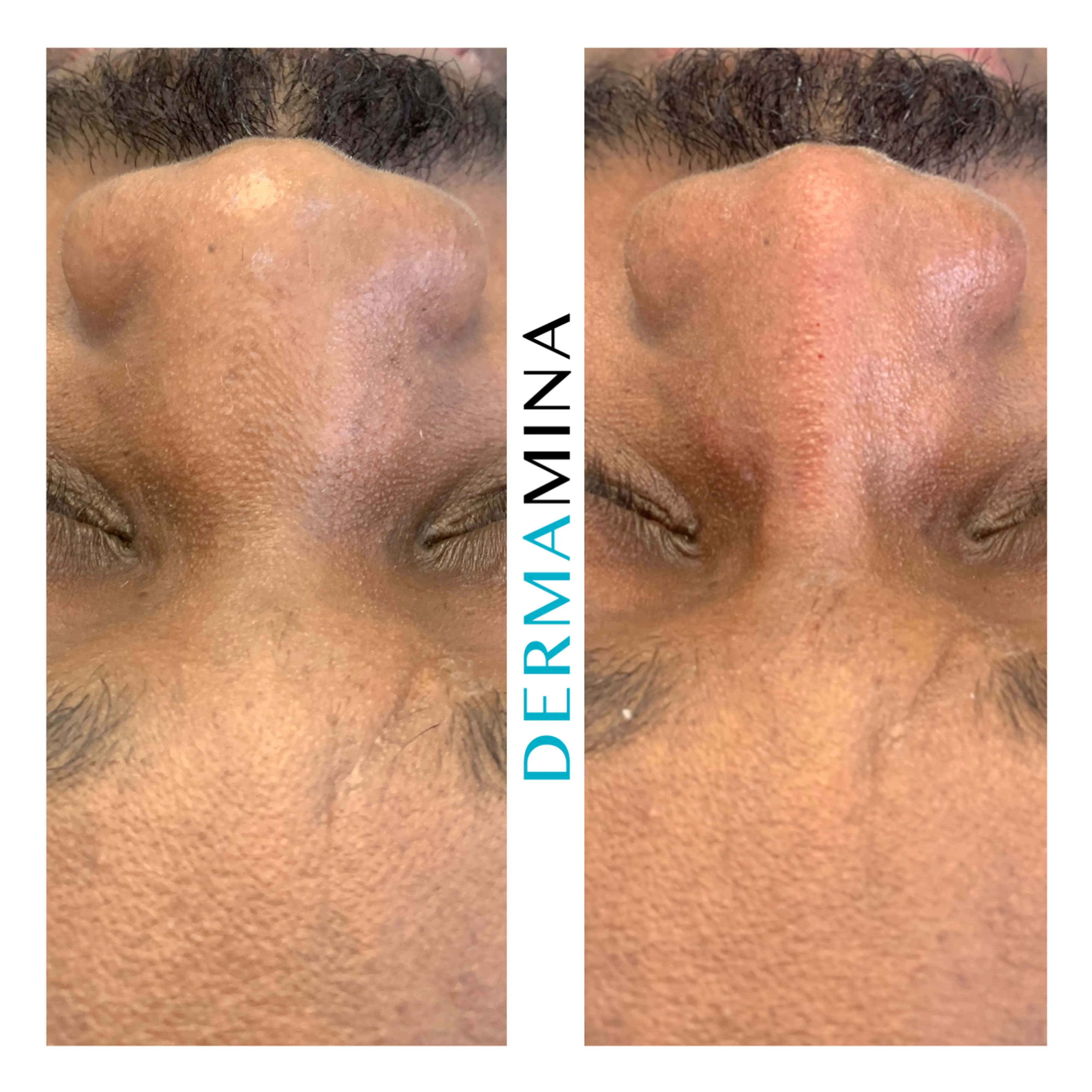 Non-surgical nose job before and after at Dermamina London, wide nose slimmed and narrowed