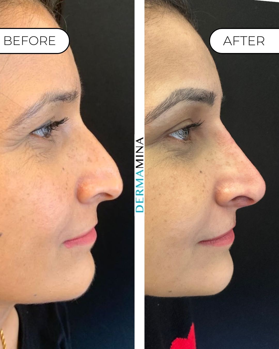 Non-surgical nose job before and after at Dermamina London, droopy tip lifted and refined