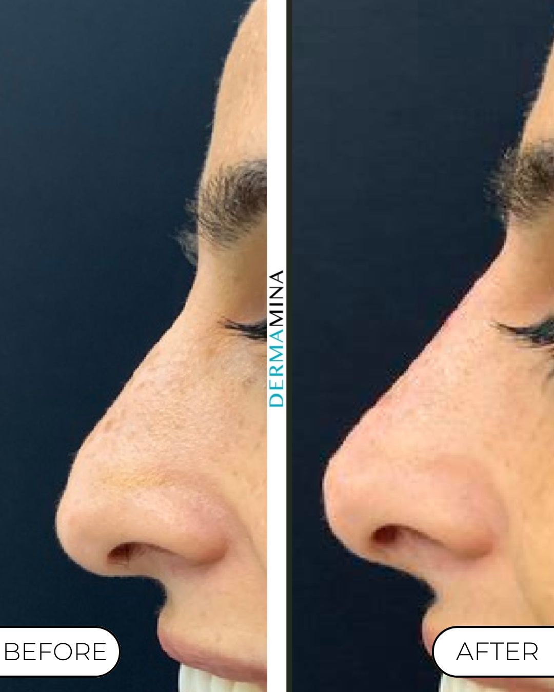 Non-surgical nose job before and after at Dermamina London, droopy tip lifted and refined
