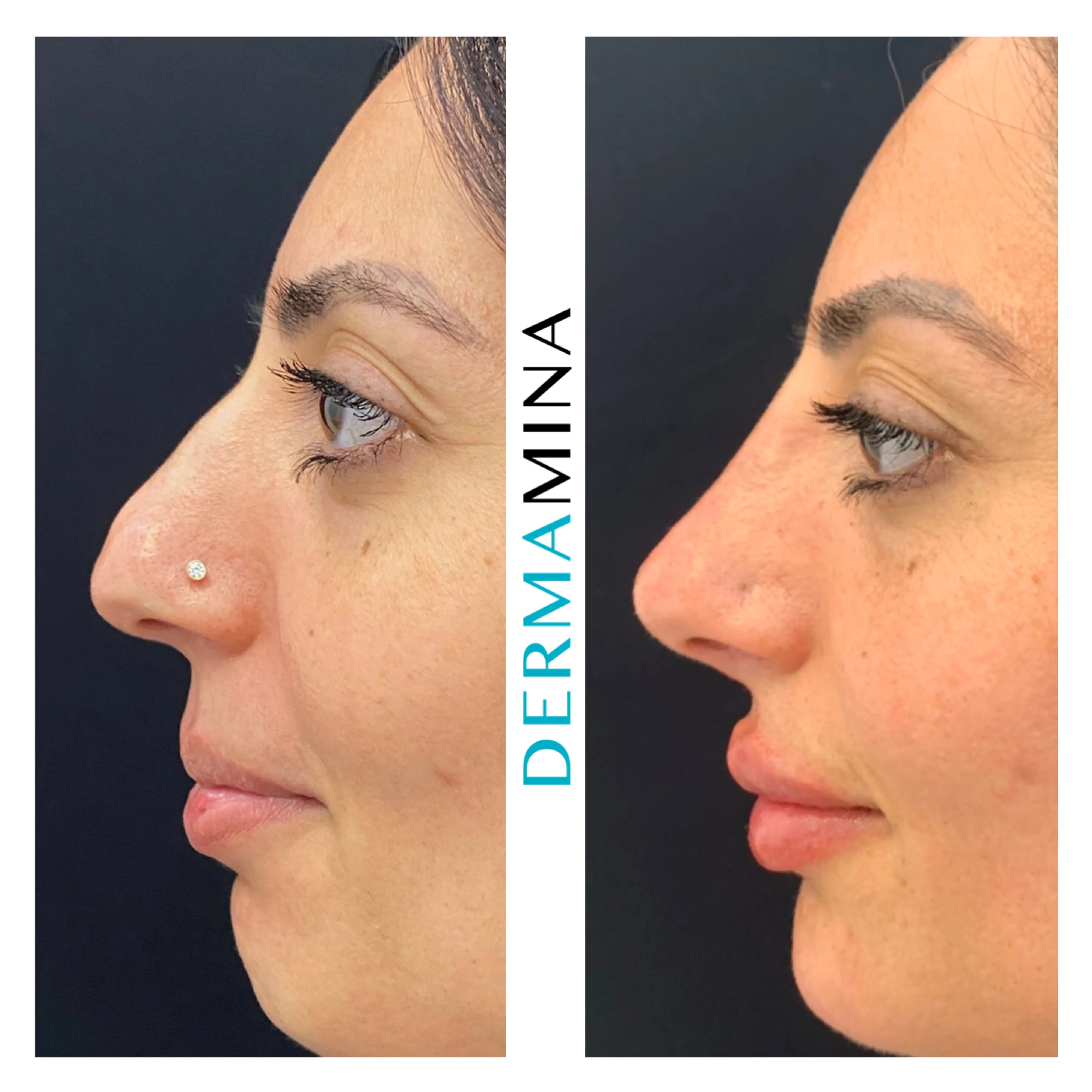 Non-surgical nose job before and after at Dermamina London, droopy tip lifted and refined