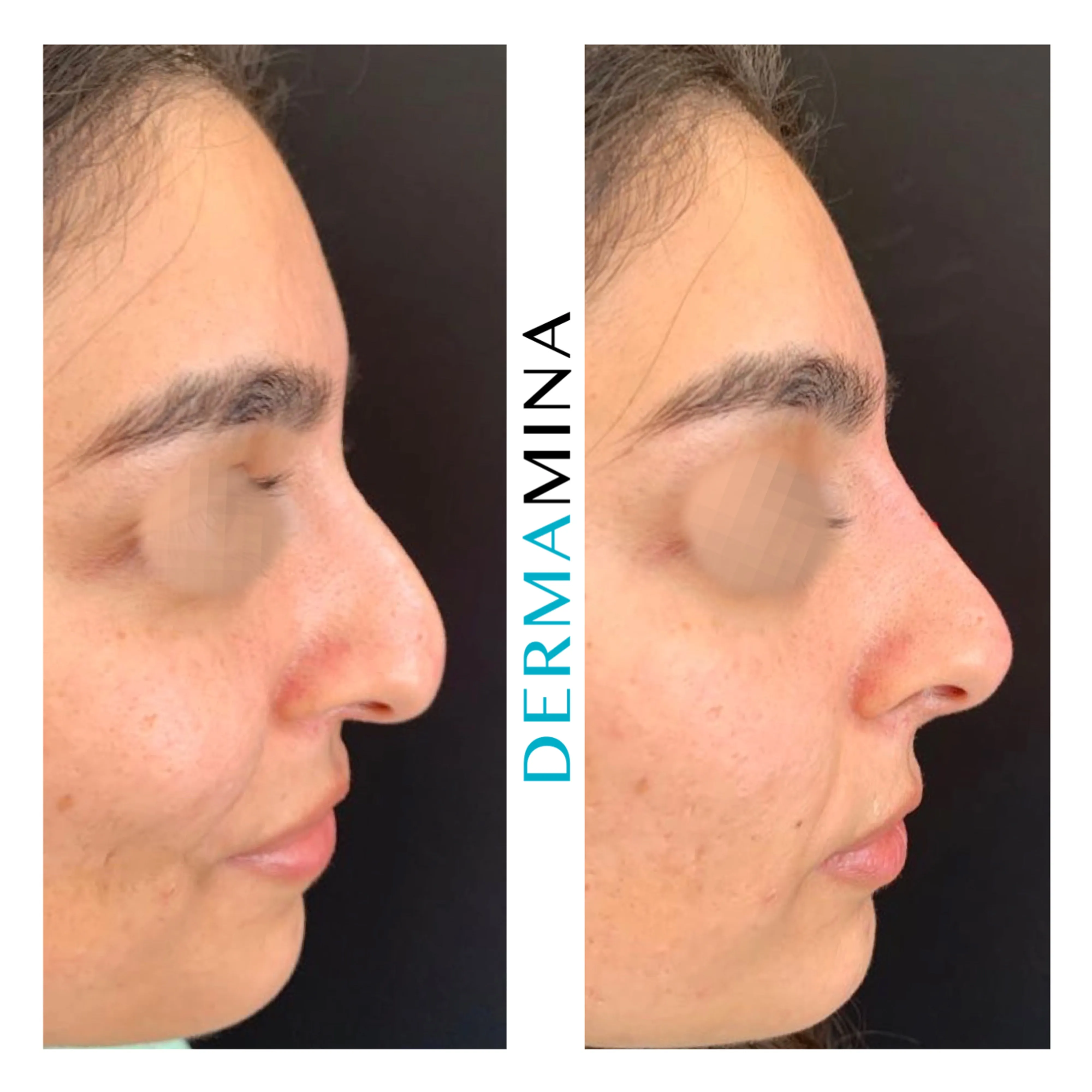 Non-surgical nose job before and after at Dermamina London, droopy tip lifted and refined