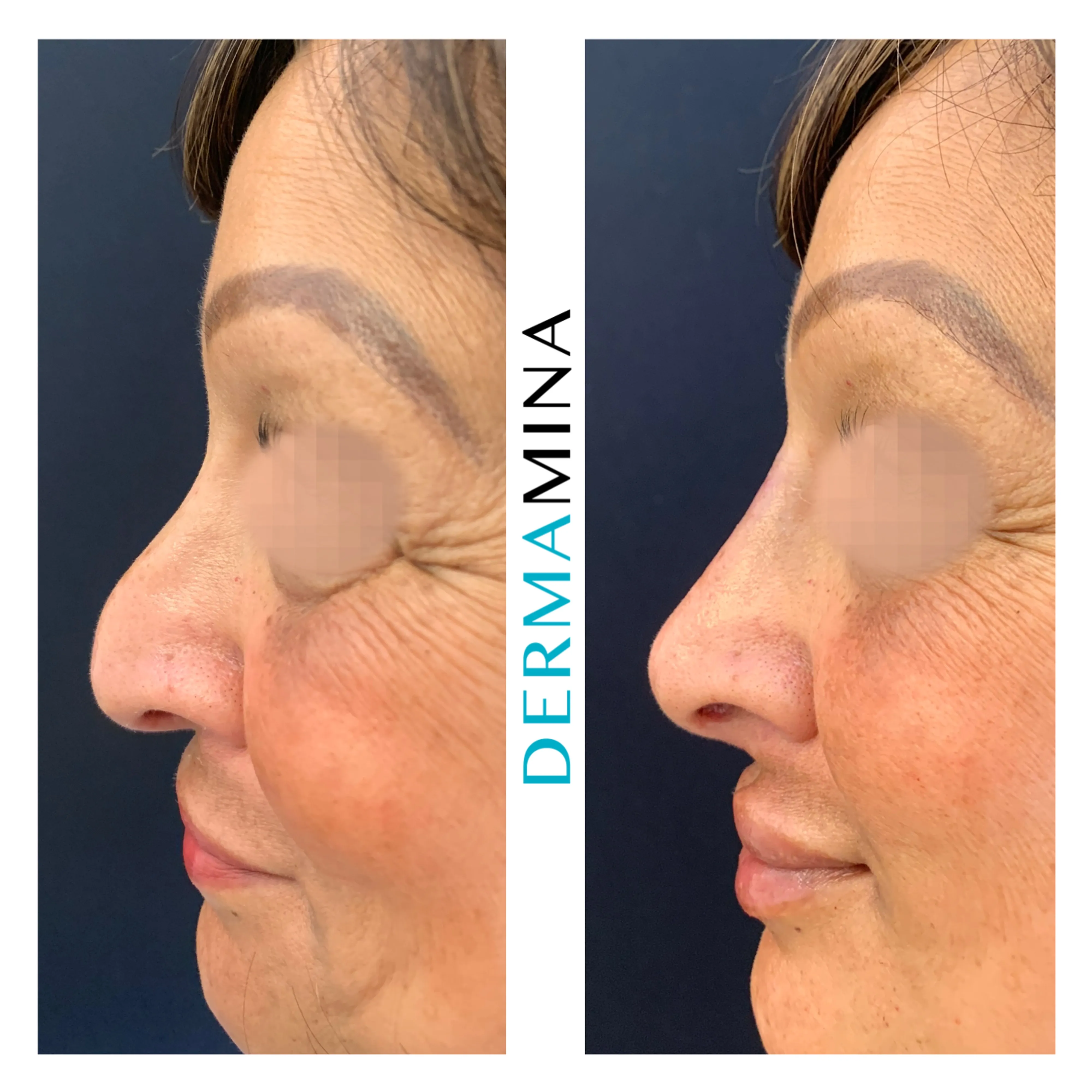 Non-surgical nose job before and after at Dermamina London, droopy tip lifted and refined