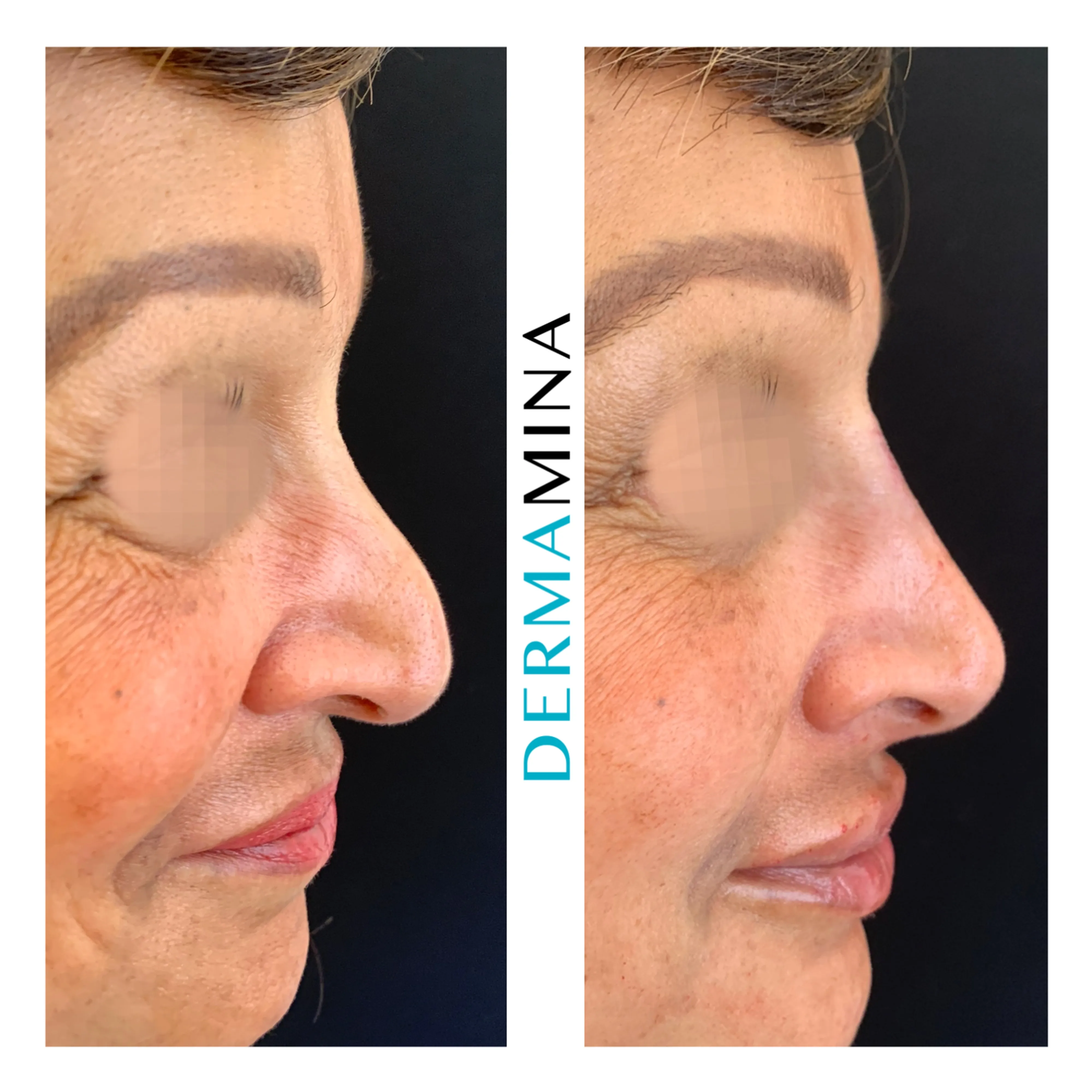 Non-surgical nose job before and after at Dermamina London, droopy tip lifted and refined