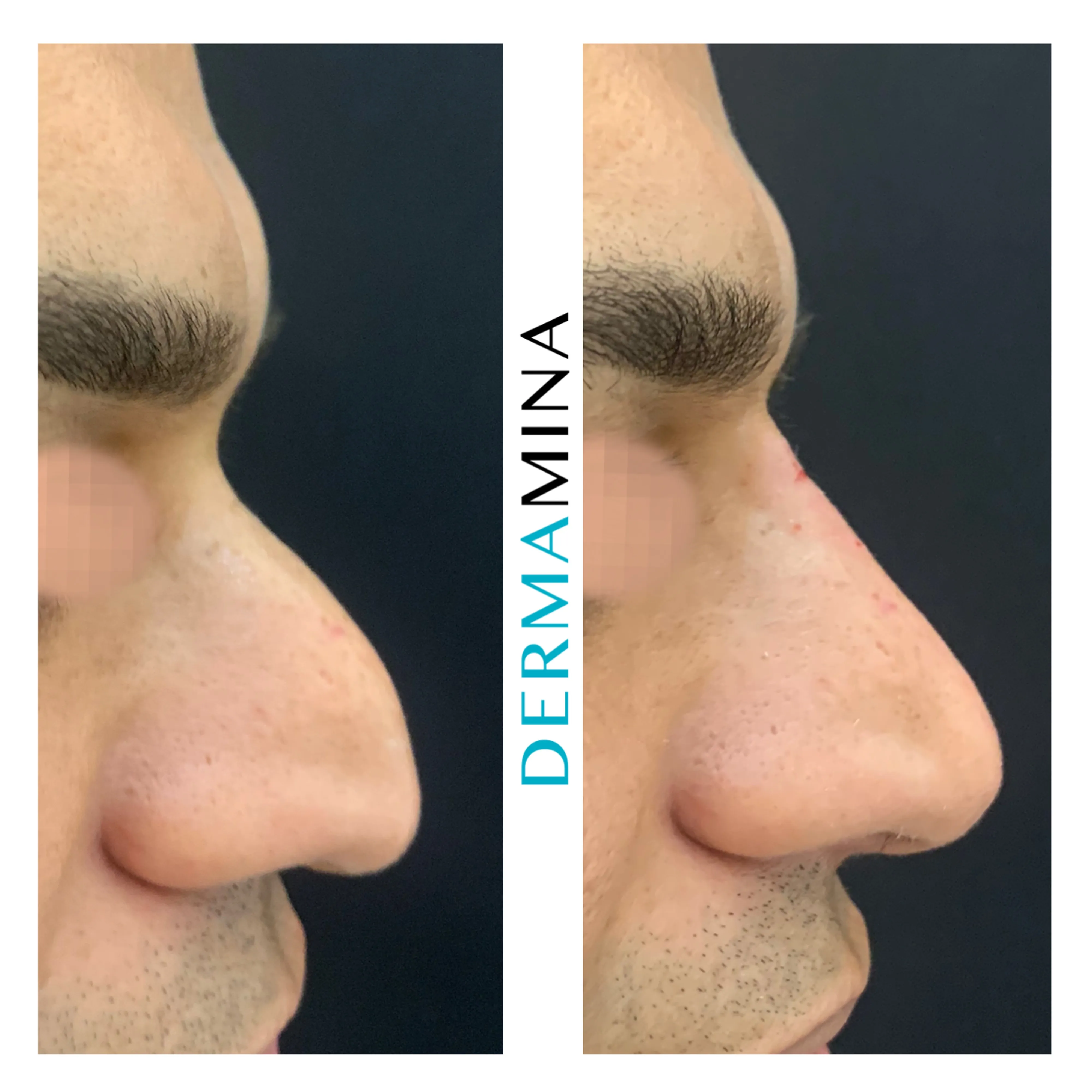 Non-surgical nose job before and after at Dermamina London, droopy tip lifted and refined