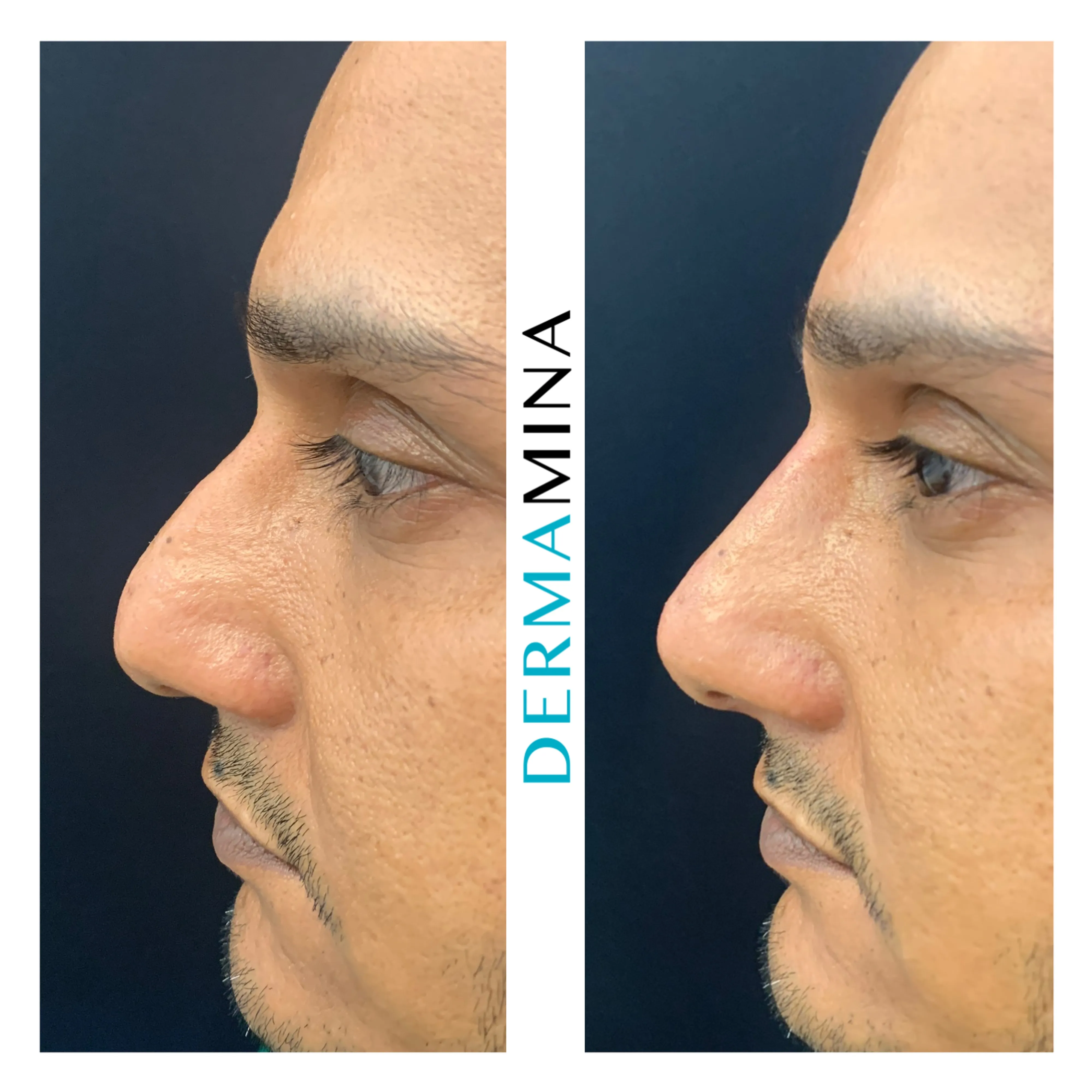 Non-surgical nose job before and after at Dermamina London, droopy tip lifted and refined