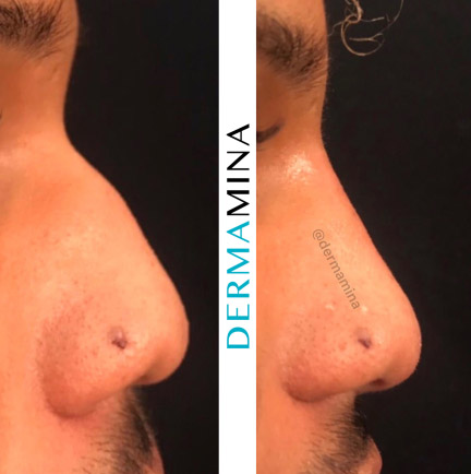 Non-surgical nose job before and after at Dermamina London, result 10