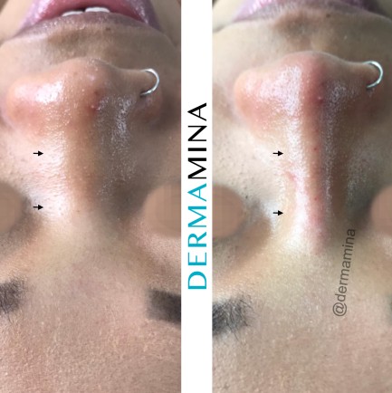Non-surgical nose job before and after at Dermamina London, result 9