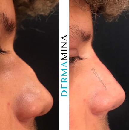 Non-surgical nose job before and after at Dermamina London, result 8
