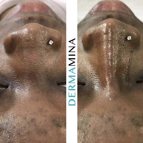 Non-surgical nose job before and after at Dermamina London, result 7
