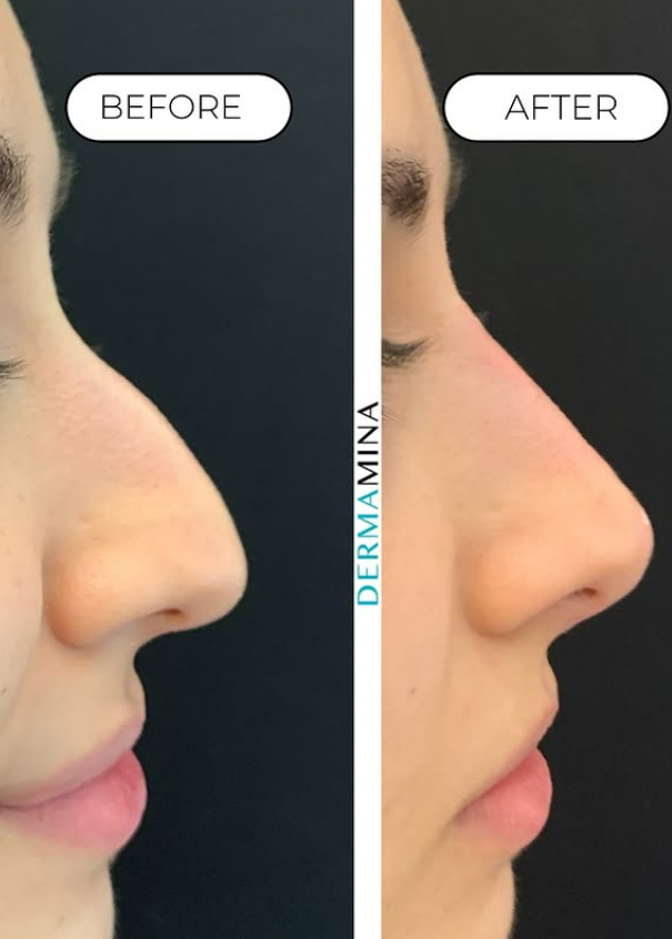 Non-surgical nose job before and after at Dermamina London, result 15