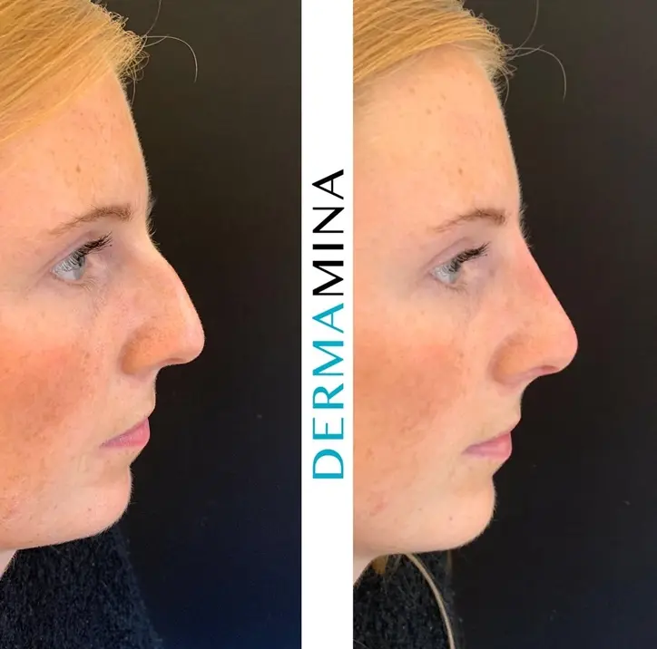 Before and after Non Surgical Nose Job