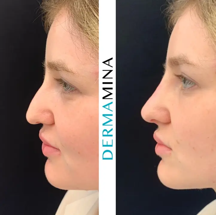 Before and after Non Surgical Nose Job