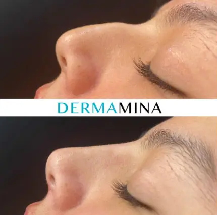 Before and after Non Surgical Nose Job