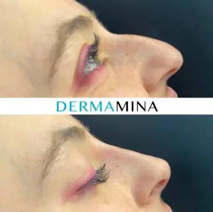 Before and after Non Surgical Nose Job