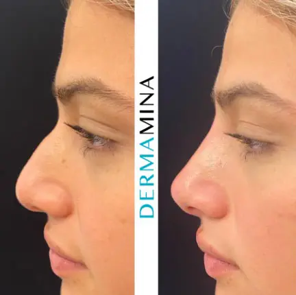 Before and after Non Surgical Nose Job