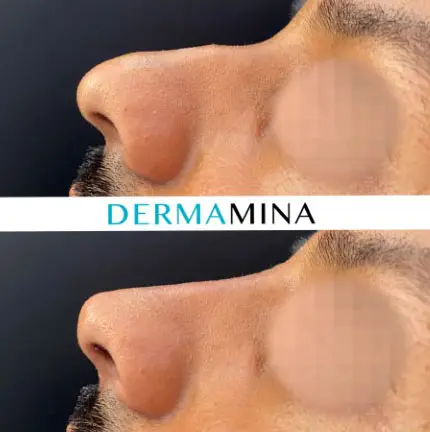 Before and after Non Surgical Nose Job