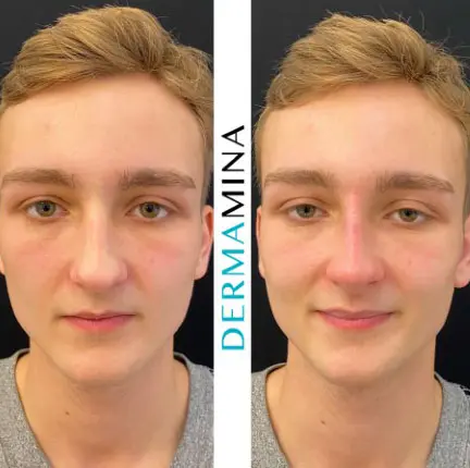 Before and after Non Surgical Nose Job