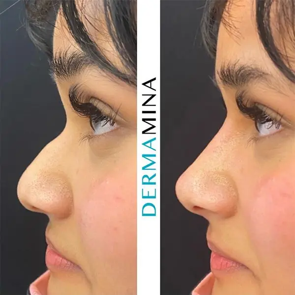 Before and after Non Surgical Nose Job