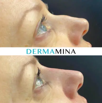 Before and after Non Surgical Nose Job