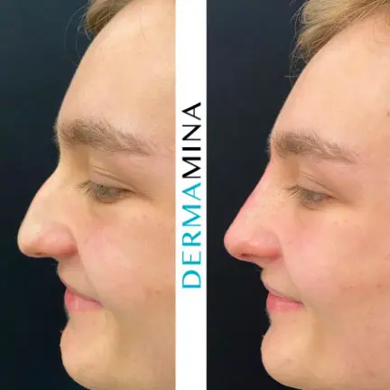 Before and after Non Surgical Nose Job