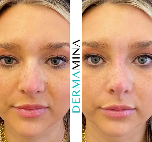 Before and after Non Surgical Nose Job