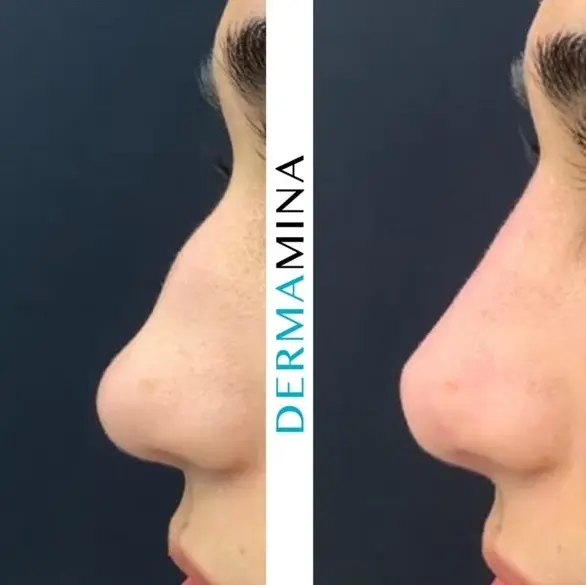 Before and after Non Surgical Nose Job