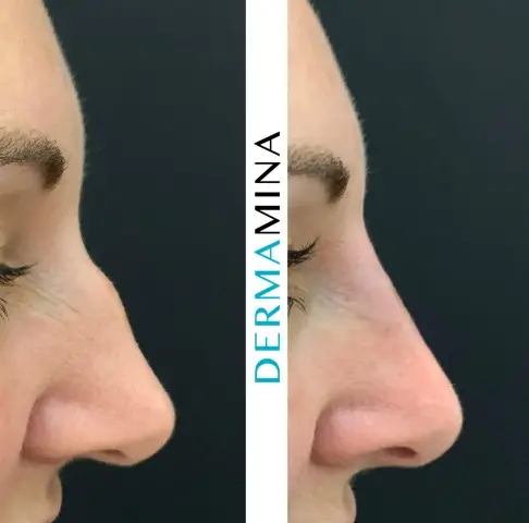 Before and after Non Surgical Nose Job