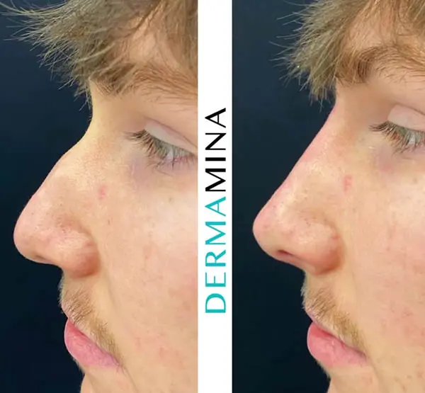 Before and after Non Surgical Nose Job