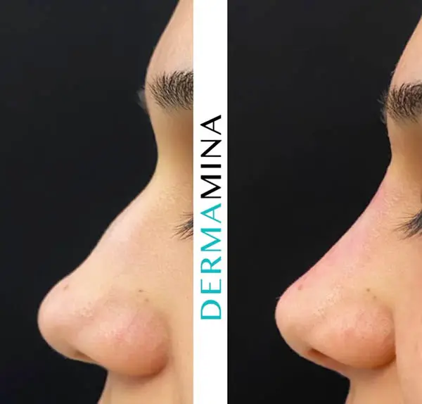 Before and after Non Surgical Nose Job