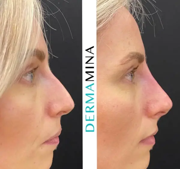 Before and after Non Surgical Nose Job