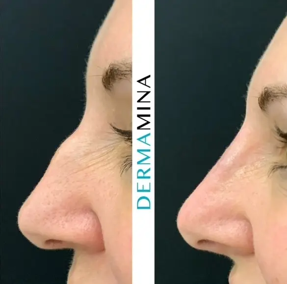 Before and after Non Surgical Nose Job