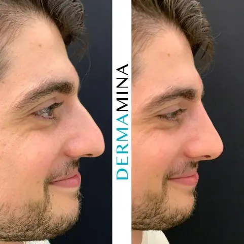 Before and after Non Surgical Nose Job