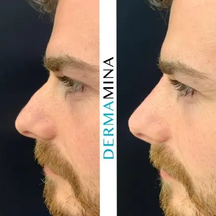 Before and after Non Surgical Nose Job