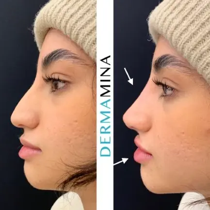 Before and after Non Surgical Nose Job