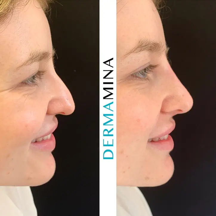 Before and after Non Surgical Nose Job