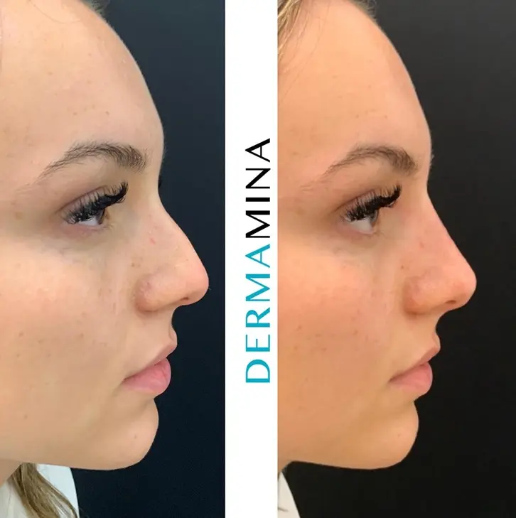 Before and after Non Surgical Nose Job