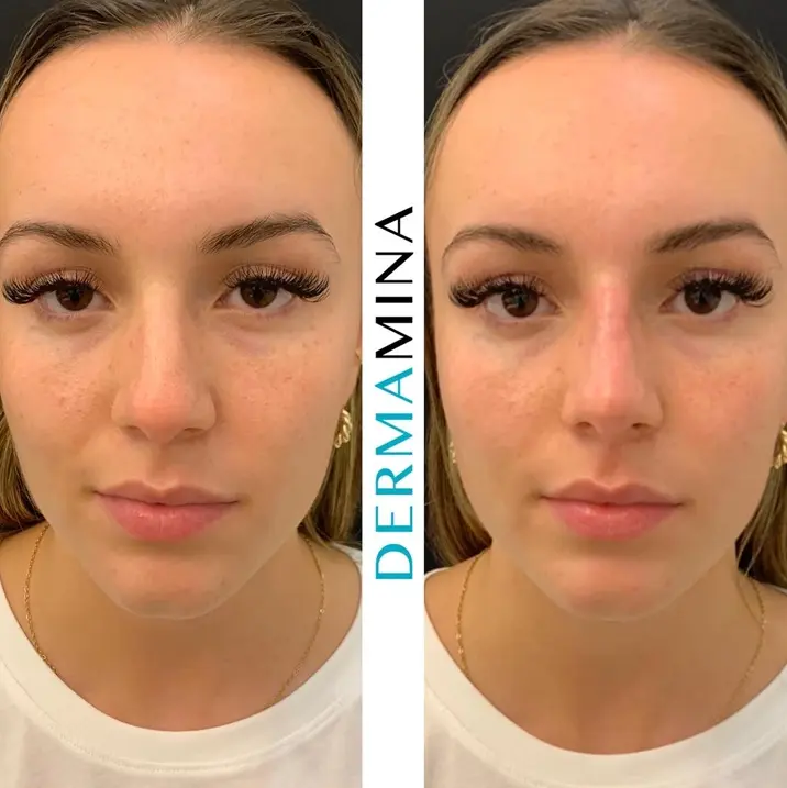 Before and after Non Surgical Nose Job